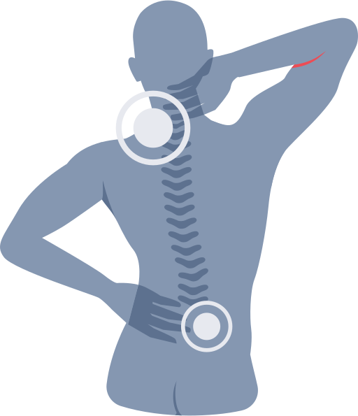 Cervical Spondylosis