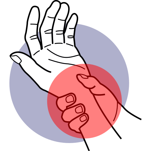 Carpal Tunnel Syndrome